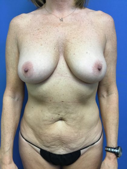 Breast Augmentation Before & After Patient #603
