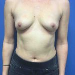 Breast Augmentation Before & After Patient #608