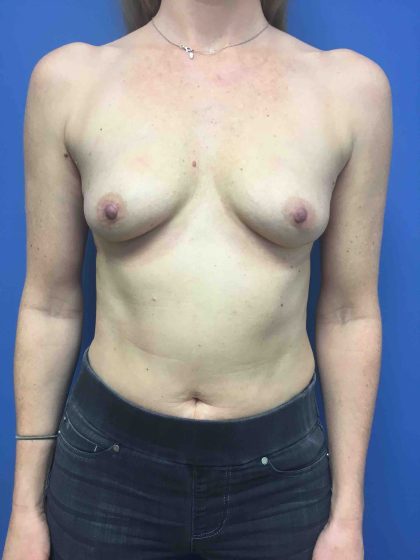 Breast Augmentation Before & After Patient #608