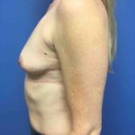 Breast Augmentation Before & After Patient #608