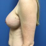 Breast Augmentation Before & After Patient #608
