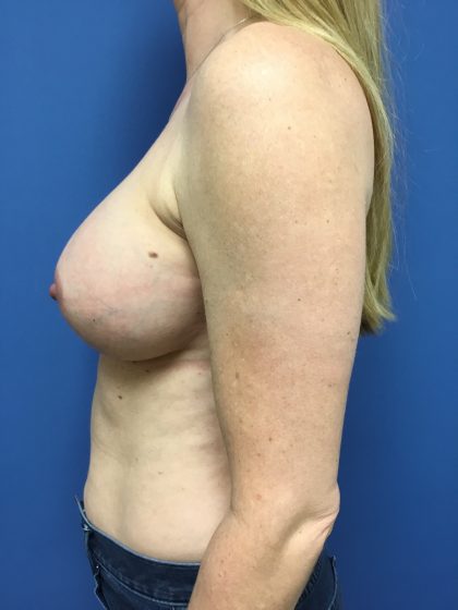 Breast Augmentation Before & After Patient #608