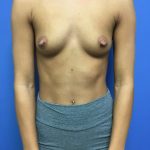 Breast Augmentation Before & After Patient #613