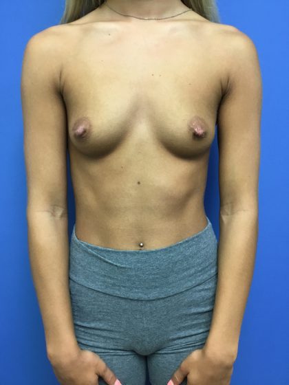 Breast Augmentation Before & After Patient #613