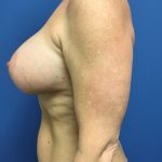 Breast Augmentation Before & After Patient #618