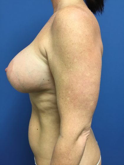 Breast Augmentation Before & After Patient #618