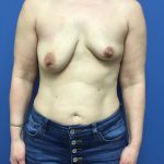 Breast Augmentation Before & After Patient #623