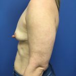 Breast Augmentation Before & After Patient #623