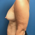 Breast Augmentation Before & After Patient #623