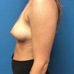 Breast Augmentation Before & After Patient #633