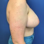 Breast Augmentation Before & After Patient #638