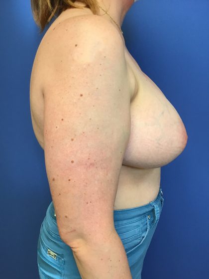 Breast Augmentation Before & After Patient #638