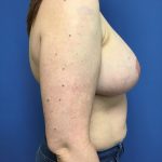 Breast Augmentation Before & After Patient #638