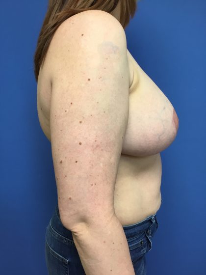Breast Augmentation Before & After Patient #638