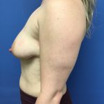 Breast Augmentation Before & After Patient #643