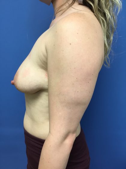 Breast Augmentation Before & After Patient #643