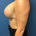 Breast Augmentation Before & After Patient #643