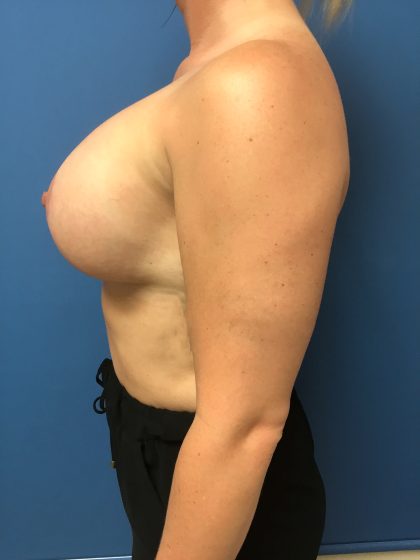Breast Augmentation Before & After Patient #643