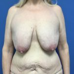 Breast Augmentation Before & After Patient #648