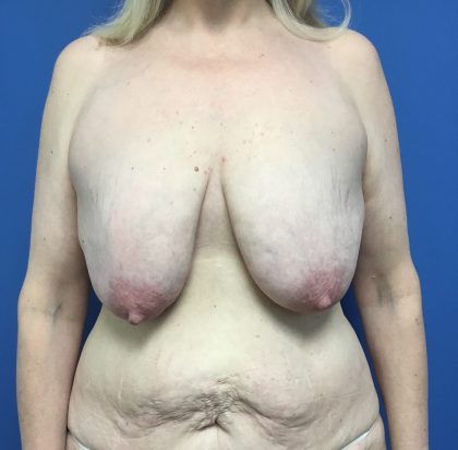 Breast Augmentation Before & After Patient #648