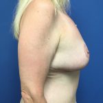 Breast Augmentation Before & After Patient #648