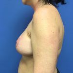 Breast Augmentation Before & After Patient #653