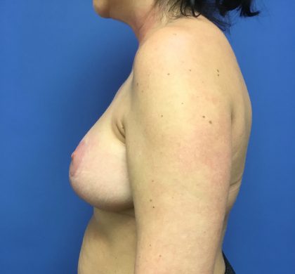 Breast Augmentation Before & After Patient #653