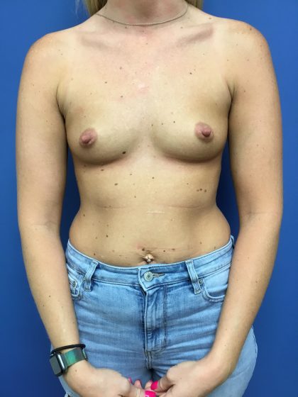 Breast Augmentation Before & After Patient #658