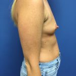 Breast Augmentation Before & After Patient #658