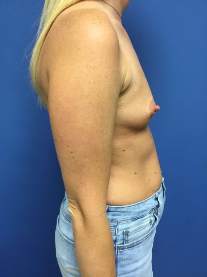 Breast Augmentation Before & After Patient #658