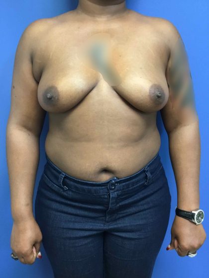 Breast Augmentation Before & After Patient #663