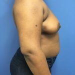 Breast Augmentation Before & After Patient #663