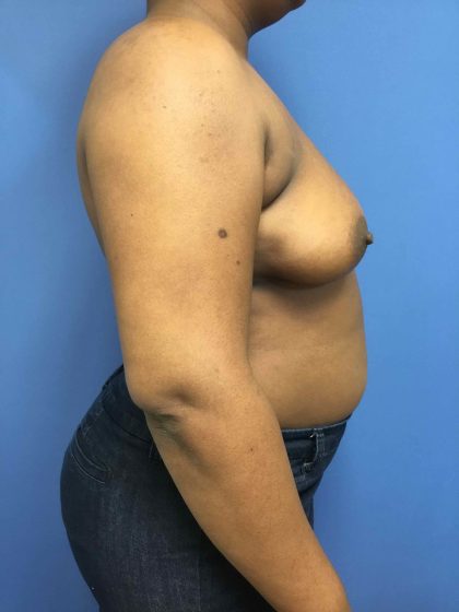 Breast Augmentation Before & After Patient #663