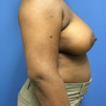 Breast Augmentation Before & After Patient #663