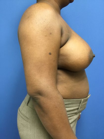 Breast Augmentation Before & After Patient #663