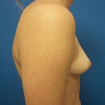 Breast Augmentation Before & After Patient #668