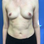 Breast Augmentation Before & After Patient #678
