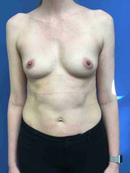 Breast Augmentation Before & After Patient #678