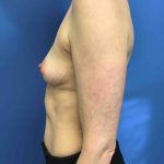 Breast Augmentation Before & After Patient #678
