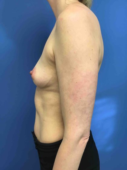 Breast Augmentation Before & After Patient #678