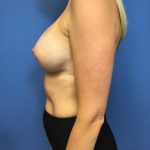 Breast Augmentation Before & After Patient #678