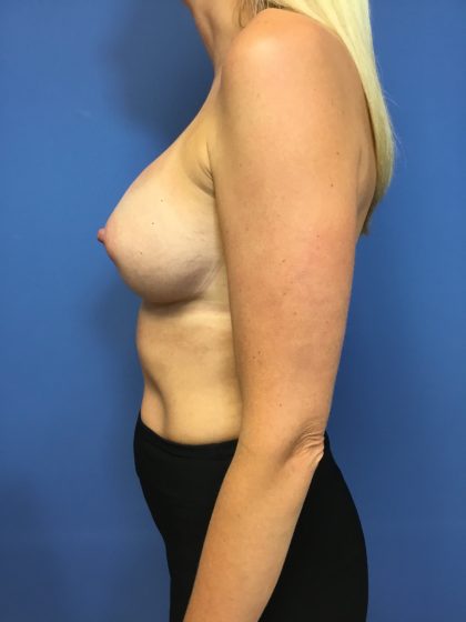 Breast Augmentation Before & After Patient #678