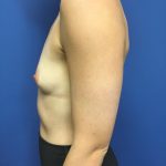 Breast Augmentation Before & After Patient #683