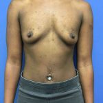 Breast Augmentation Before & After Patient #698
