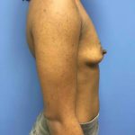 Breast Augmentation Before & After Patient #698