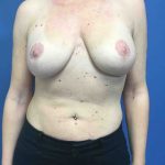 Breast Augmentation Before & After Patient #703