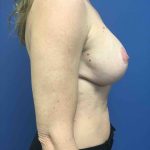 Breast Augmentation Before & After Patient #703