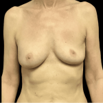 Breast Reduction Before & After Patient #1439
