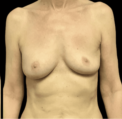 Breast Reduction Before & After Patient #1439