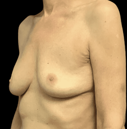 Breast Reduction Before & After Patient #1439